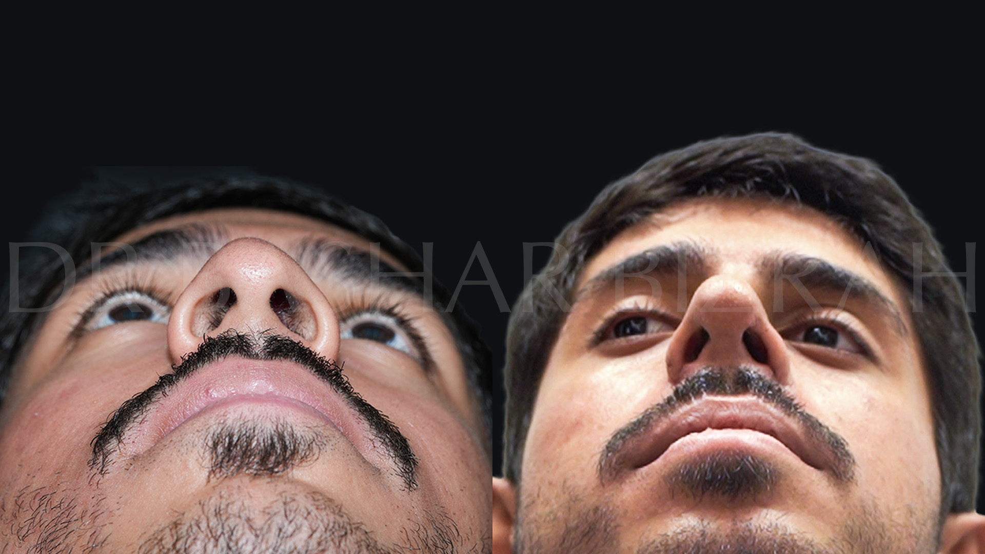 Rhinoplasty (4)