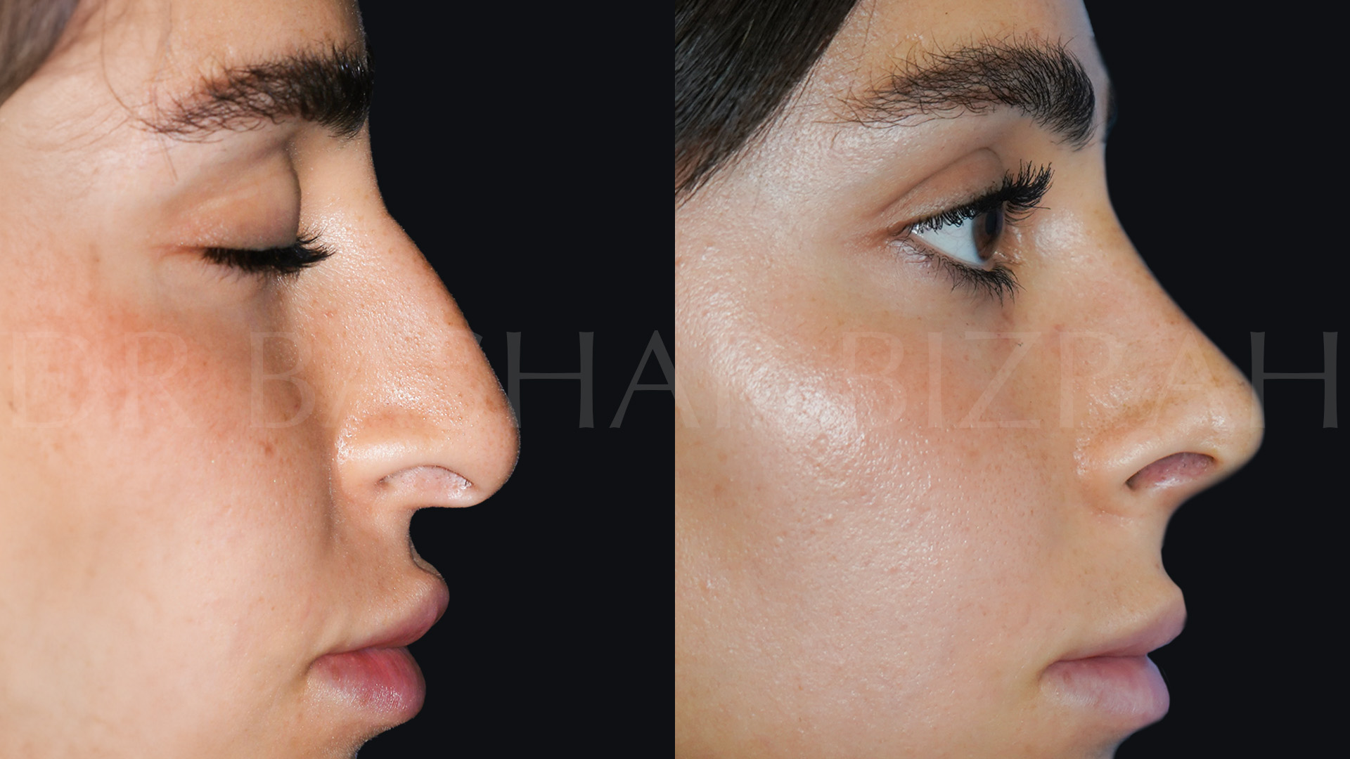 Rhinoplasty (5)