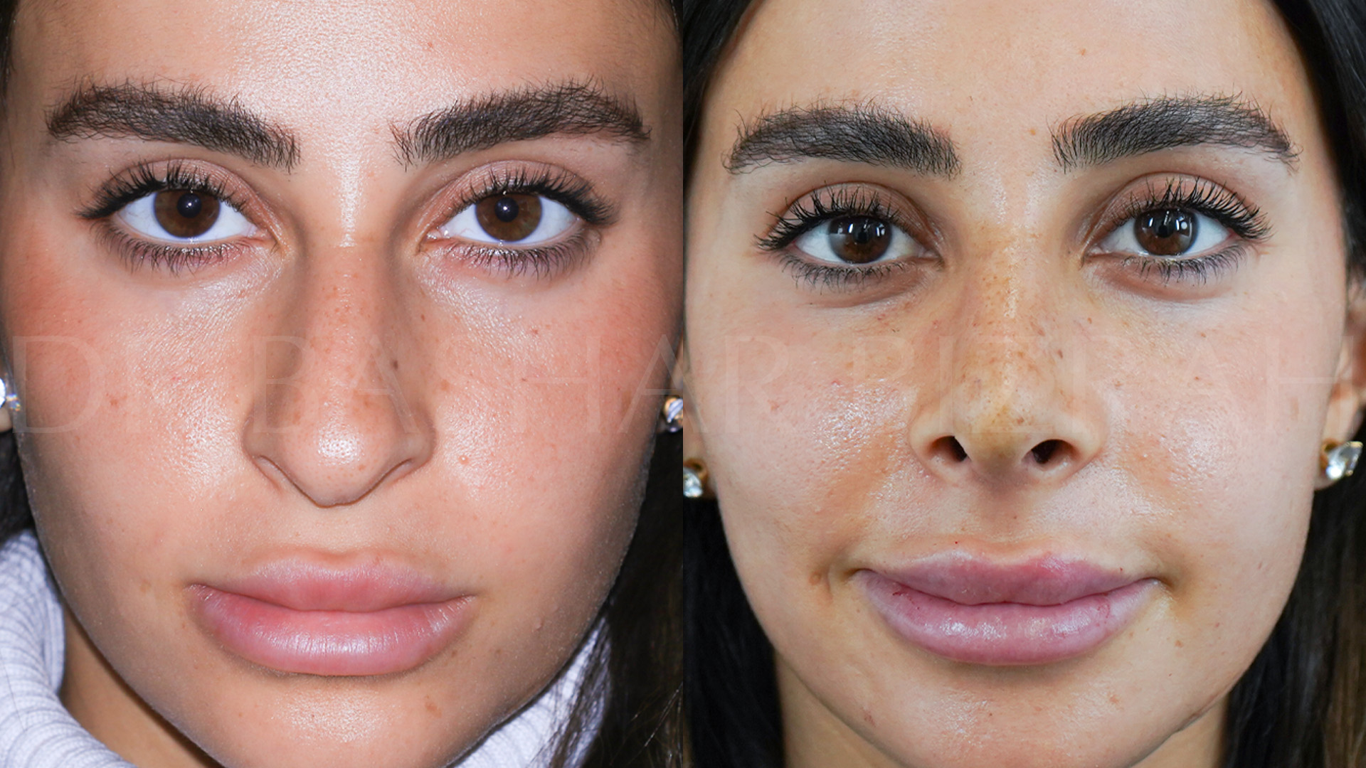 Rhinoplasty (6)