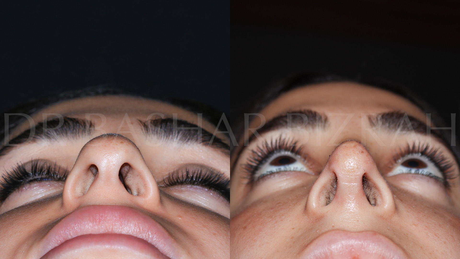Rhinoplasty (7)
