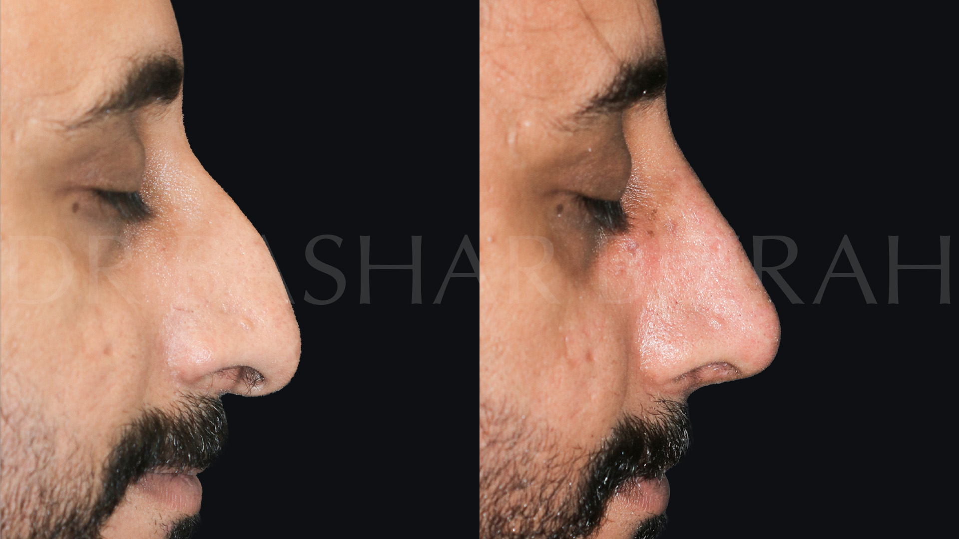 Rhinoplasty (8)