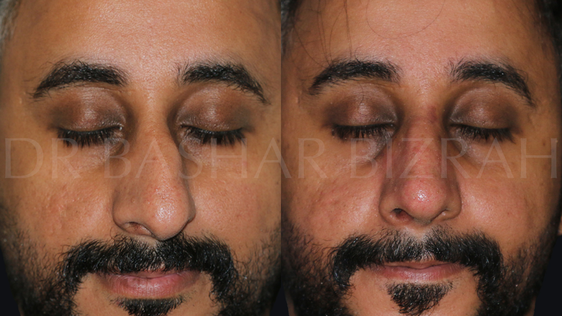 Rhinoplasty (9)